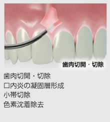 レーザー治療